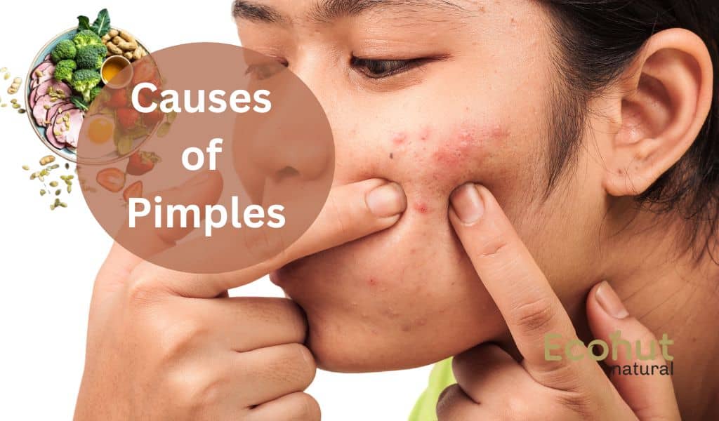 Causes of Pimples